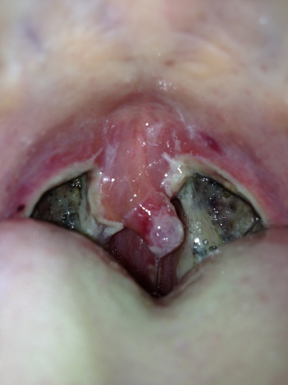 pictures of mouth sores